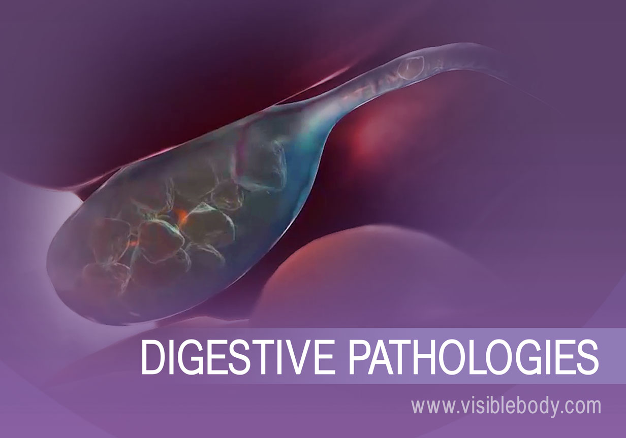 Gall stones, and example of a digestive pathology