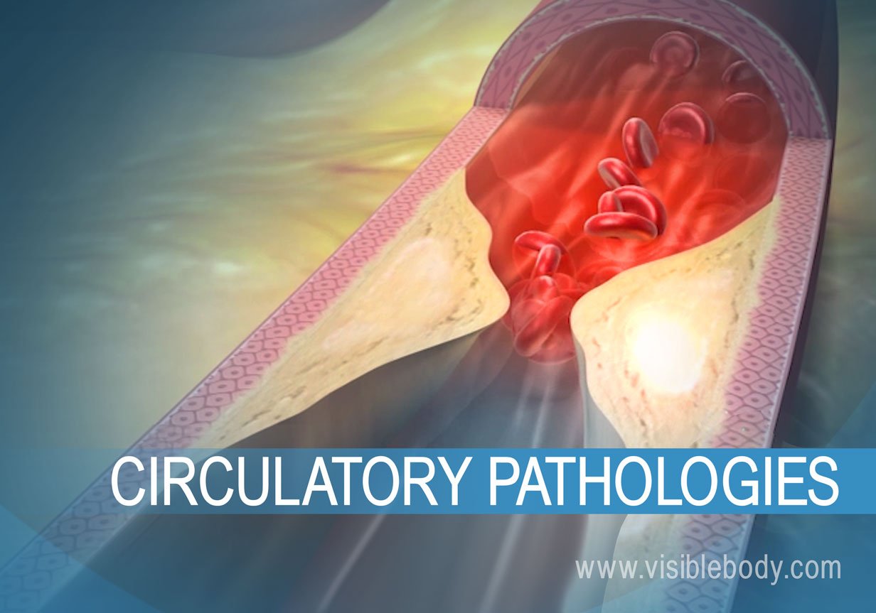 Atherosclerosis, and example of a circulatory disease