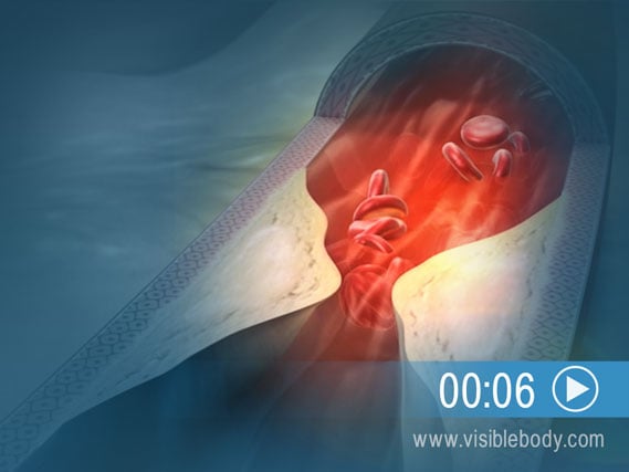 Click to play an animation of coronary artery disease