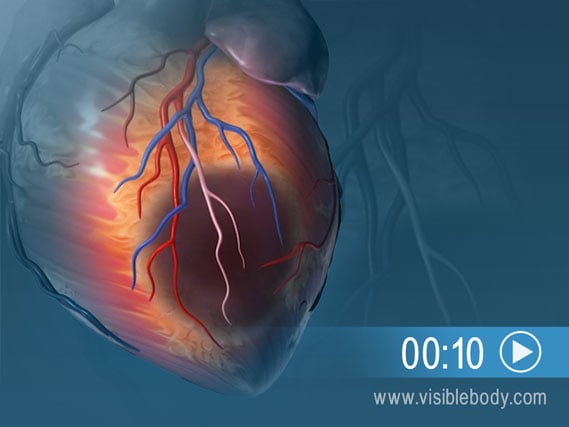 An animation of heart tissue damage due to a myocardial infarction