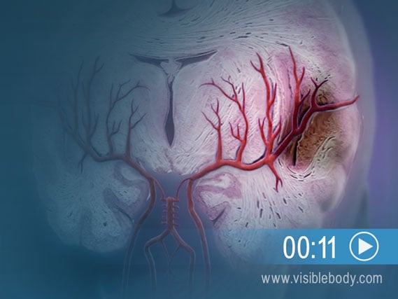 Click to see an animation of brain tissue damage due to an ischemic stroke