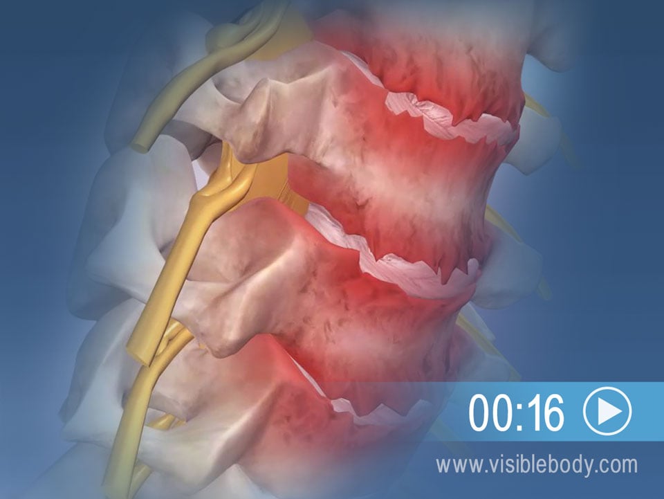 Cartilage Degenerating Over Time May Lead to Cervical Spondylosis