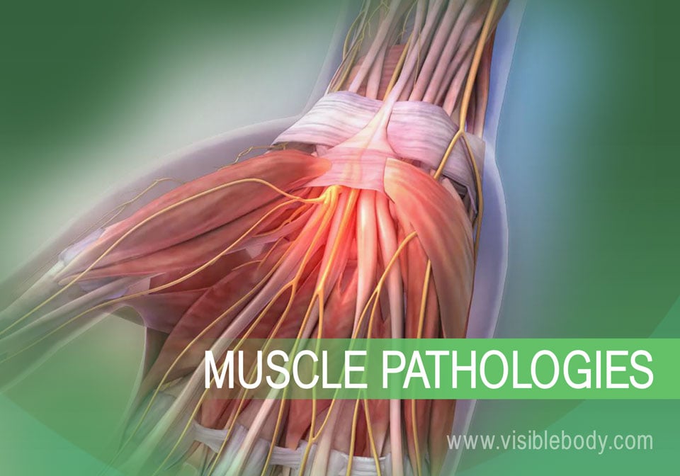 Muscular System Pathologies: Common Disorders and Conditions