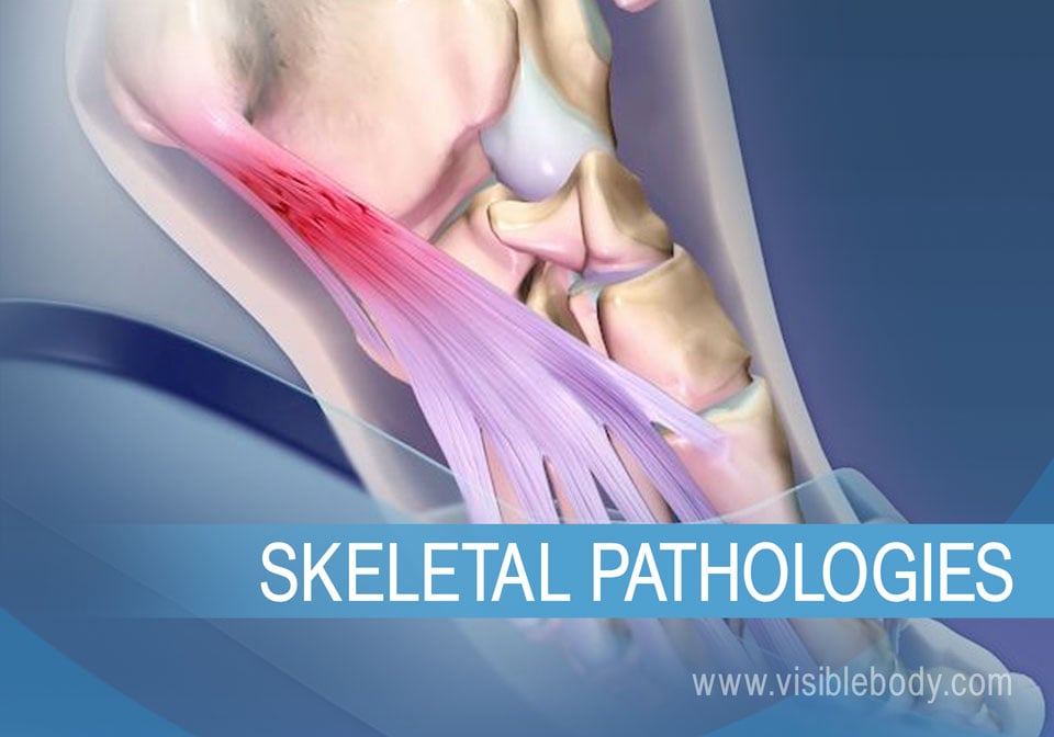 The pathologies described below can occur when stress and aging affect the skeletal system.